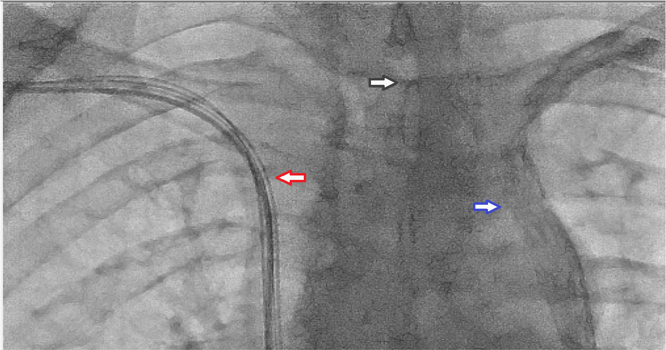 Figure 3. The red arrow shows the leads originating from the right sided battery and the black arrow shows the regressed innominate vein in a tapered aspect. Persistent left vena cava superior is also visible with a downwards flow (Blue arrow).